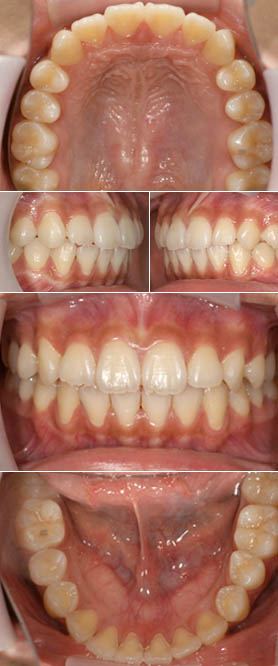 出っ歯のいなべ市の子どもの矯正治療後のお口中の写真