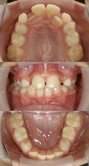 矯正治療前の四日市市の子どもの歯の写真