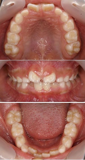 矯正治療前の鈴鹿市の子どもの歯の写真