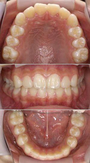 矯正治療後の鈴鹿市の子どもの歯の写真