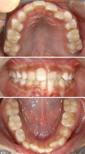 矯正治療前の歯の写真