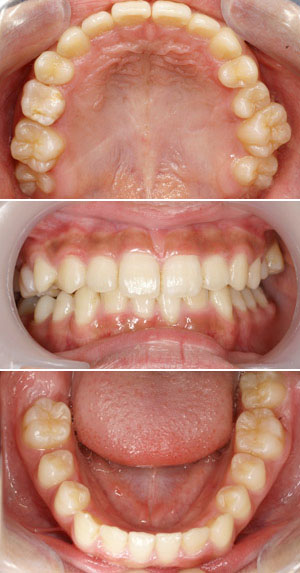 矯正治療中の歯の写真