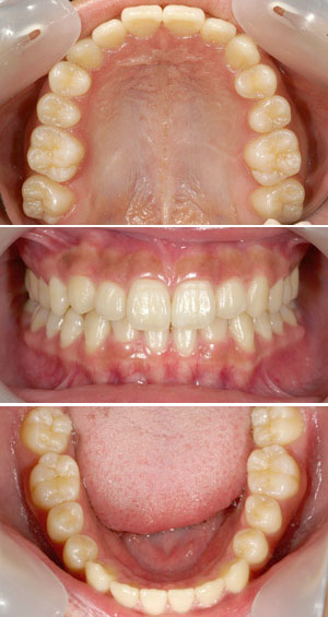 矯正治療後ろの歯の写真