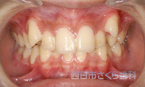 八重歯の治療前の写真