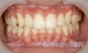 八重歯を矯正治療した後の写真