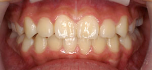 悪い歯ならびを矯正治療した後の写真