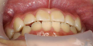 矯正治療により前歯が咬んでいることを示す写真