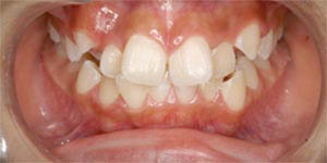 上下の永久歯のスペースが足りない口腔内写真