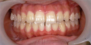 別装置で矯正を行い、綺麗に並んだ歯の写真