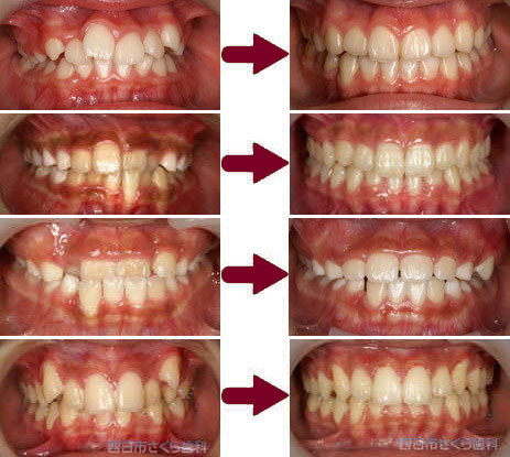 歯を抜かない歯ならびの治療の写真