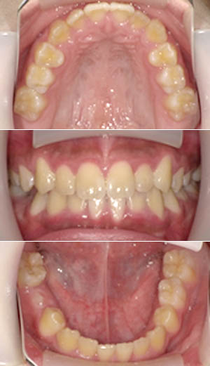 その後歯ならびを治療した後の口腔内写真