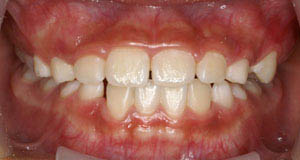 その後歯ならびの治療中の口腔内写真