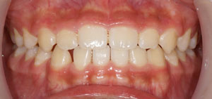 歯ならびの治療も終了した時点の口腔内写真