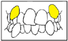 八重歯の図